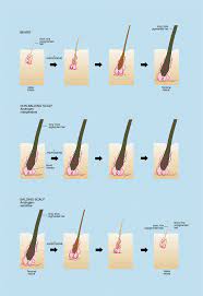 At the point when your body connects with ru58841, it delivers a compound known as cyanonilutamide, which has i have helped many to stop hair loss and regrow hair. Androgens And Hair Growth Randall 2008 Dermatologic Therapy Wiley Online Library