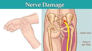 There Are Billions Of Nerves In Your Body You Read That Right Billions Your Peripheral Nerves Which Make Up The Ma In 2020 Nerve Damage Nerve Damage Symptoms Nerve