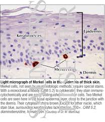Merkel cell carcinoma is a highly aggressive primary cutaneous neuroendocrine carcinoma primarily affecting elderly and immunosuppressed individuals. Light Micrograph Of Merkel Cells In The Epidermis Of Thick Skin