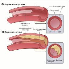 Serdechno Sosudistye Riski Pri Saharnom Diabete