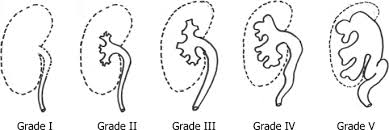 Current Management Of Urinary Tract Infection And Vesicoureteral Reflux Springerlink