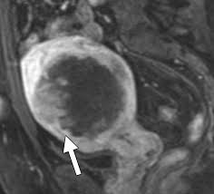 Image result for Leiomyosarcoma