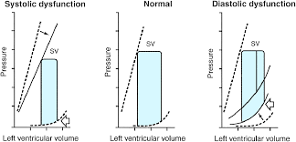 Image result for Systolic Dysfunction