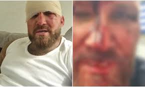 Pokazano twarze zawodników po walce na gołe pięści. Drastyczne zdjęcia