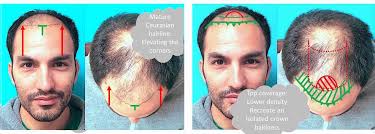 We help you find the best clinic at the best price. Simplified Hairline Design A Focus On Shape And Position Hair Transplants Los Angeles San Francisco Parsa Mohebi Hair Restoration