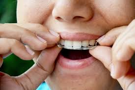 Every two weeks, to be safe. What Happens If I Don T Wear My Retainers The Orthodontic Center Of Wayne Dr Sally Song Orthodontist Wayne Nj