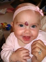 Jocelynn's Hemangioma