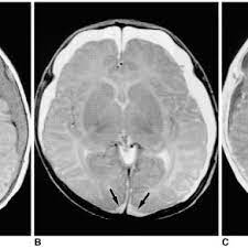 Pdf Mr Imaging Of Shaken Baby Syndrome Manifested As Chronic Subdural Hematoma