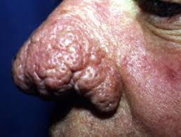 Manche bereiten den lwenzahn mit einem besonderen hausrezept zusammen mit brennnesseln zur schmackhaften suppe, oder als beilage zu kr?uterquark Rosacea Dermnet Nz