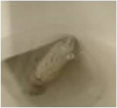 Image result for acholic stools human