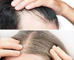 Perdita dei capelli, quali possono essere le cause? Revitensin Rinforza I Capelli