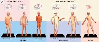 Informational Graphic On The Different Types Of Cerebral Palsy Cerebral Palsy What Is Cerebral Palsy Pediatric Physical Therapy
