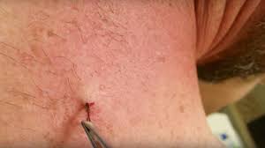Try washing the area with soap and water and exfoliating the area with. This Viral Video Of A Six Year Old Ingrown Hair Being Removed Is Frightening Allure