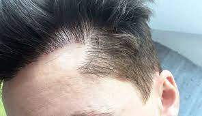 What To Expect After Fue Hair Transplant Surgery Fue Hair Transplant