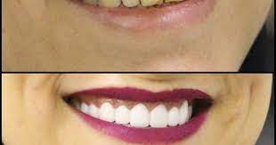 pin by رانيه رسول on مرات الحفظ السريع in 2021 dental teeth eyeliner