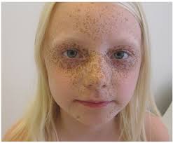 Cutaneous Expression of Familial Cancer Syndromes