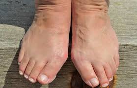Painful lump, bump, thickening, or growth on toe or foot. Bunions La Orthopedic Pain Center