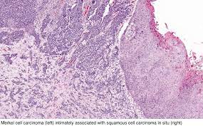 Merkel cell carcinoma version 1.2020 — october 2, 2019 continue. Pathology Outlines Merkel Cell Carcinoma