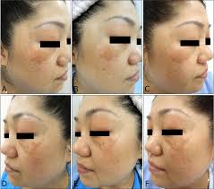 The patient who exhibited a rebound hyperpigmentation without purpura...