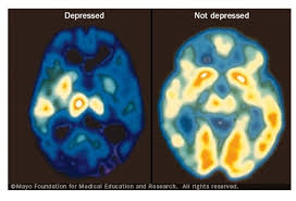 It's a common symptom of depression as well as other mental health disorders. Ø¯Ø§Ø¦Ø±Ø© Ø¯Ù…Ø§Øº ÙˆØ§Ø­Ø¯Ø© Ù‡ÙŠ Ø£Ø³Ø§Ø³ ÙƒÙ„ Ù…Ù† Ø§Ù„Ø¥Ø¯Ù…Ø§Ù† ÙˆØ§Ù„Ø¥ÙƒØªØ¦Ø§Ø¨ Ø¨Ø§Ø­Ø«ÙˆÙ†