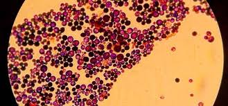 El hongo negro, el síntoma postcovid detectado en la india que puede causar la muerte los médicos alertan de un nuevo síntoma a vigilar una vez se ha superado el coronavirus. Podria Salir De La India El Hongo Negro Que Afecta A Los Supervivientes De Covid Buscandorespuestas