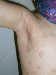 Image result for Urticaria pigmentosa children