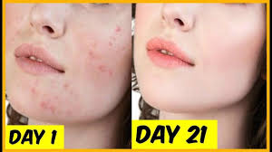 21 Days Challenge And Your Skin Will Become Extremely Clear And Spotless Pimplesscars Acne Marks How To Get Rid Of Acne How To Remove Pimples