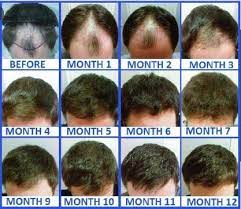 While a hair transplant is a safe and efficient procedure, it is also a long term process. Affordable And Best Fue Hair Transplant La Densitae