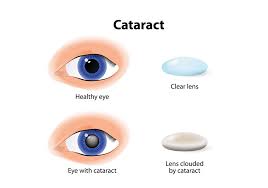 Symptoms of cataracts will vary based on the type of cataract you develop. What Are Cataracts And How Are They Treated Craftoptics