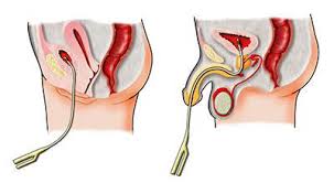 Https Www Baus Org Uk Userfiles Pages Files Patients Leaflets Intravesical 20chemotherapy Pdf