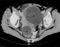 Adhesions can fixate the pelvic organs, leading to posterior displacement of uterus and ovaries the ct and mr characteristics of abdominal wall endometriosis are nonspecific, both showing a solid. Ct Atlas Glowm
