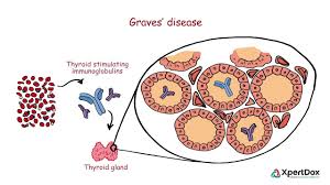 Graves' disease is a type of autoimmune disease that damages the thyroid gland. Graves Disease When Your Body Produces Too Much Thyroid Hormone Youtube