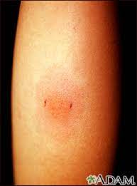 The world health organization (who) estimates that tb is 2nd only to hiv and aids as the greatest international killer. Ppd Skin Test Information Mount Sinai New York