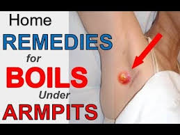 Top 3 Home Remedies For Boils Under Armpits How To Get Rid Of A Boil Under Your Armpit Fast Youtube Home Remedy For Boils Armpit Boil Boil Remedies