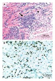 Image result for Myocarditis