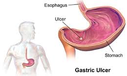 The most common symptom of a stomach ulcer is a burning or gnawing pain that develops in your abdomen (tummy). Peptic Ulcer Disease Wikipedia
