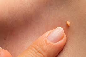 Por Que Salen Verrugas En El Cuello