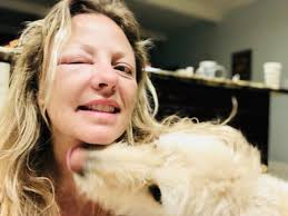 What to do if you are allergic to bees