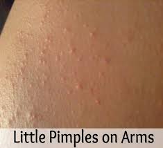 Little Pimples On Arms Natural Skin Care Diy Diy Beauty Treatments Herbalism