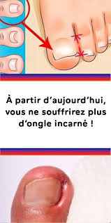 Check spelling or type a new query. Ongle Incarne Comment Traiter Sport Et Sante