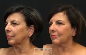 Denver women to show off inventive new facelifts