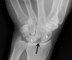 Image result for Scapholunate Dislocation