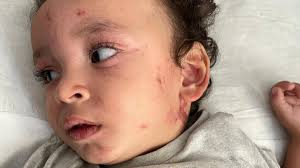 Fundraiser by Henry McClellan : Help Baby Abdullah With Treatment &  Supplies During Crisis