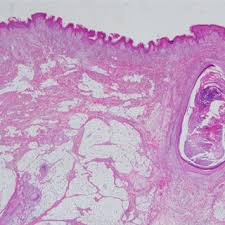 PDF) Nevus lipomatosus cutaneous superficialis