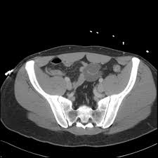 Attached to the pelvis are muscles of the buttocks, the lower back, and the thighs. Ct Abdomen Pelvis Lower Axial Labeling Questions Radiology Case Radiopaedia Org
