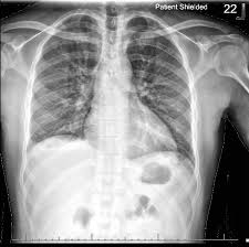 Image result for Pneumonia