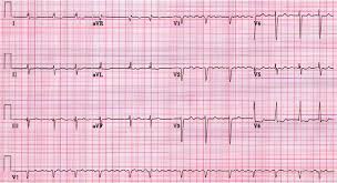 Atrial Fibrillation