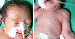Infection in pregnancy can cause miscarriage, stillbirth or a serious infection in the baby (congenital syphilis). Pdf Congenital Syphilis Presenting With A Generalized Bullous And Pustular Eruption In A Premature Newborn Semantic Scholar