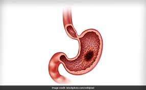 Feeling full too soon after eating, not eating, feeling sick to your stomach. Stomach Cancer 5 Things You Need To Know