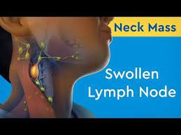 Neck Mass Swollen Lymph Node Youtube Swollen Lymph Nodes Lymph Nodes Acupressure Therapy